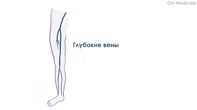 Тромбоз глубоких вен